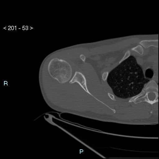 Bankart lesion with glenoid bone defect - assessment TC with PICO method (Radiopaedia 42855-93901 Axial bone window 52).jpg