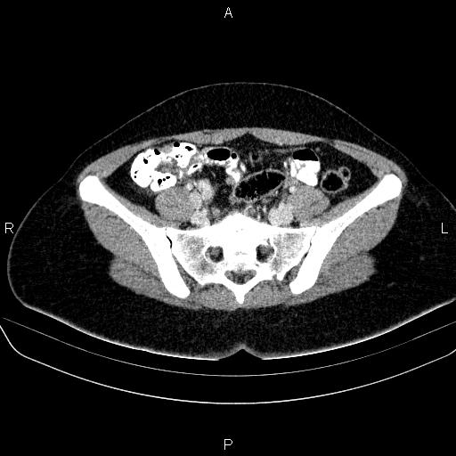 File:Bartholin gland cyst (Radiopaedia 62635-70930 Axial Post contrast 23).jpg