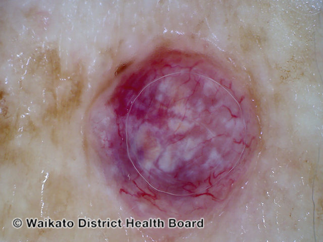 File:Basal cell carcinoma affecting the arms and legs 4 dermoscopy (DermNet NZ bcc-4-derm).jpg