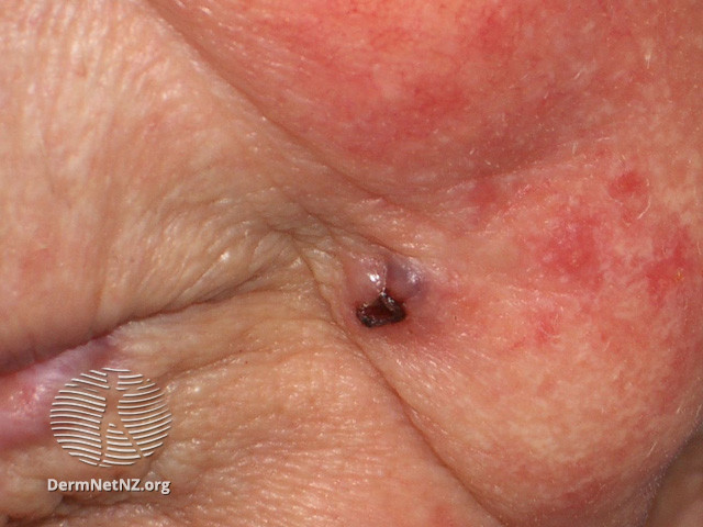 File:Basal cell carcinoma affecting the face (DermNet NZ lesions-bcc-face-1007).jpg