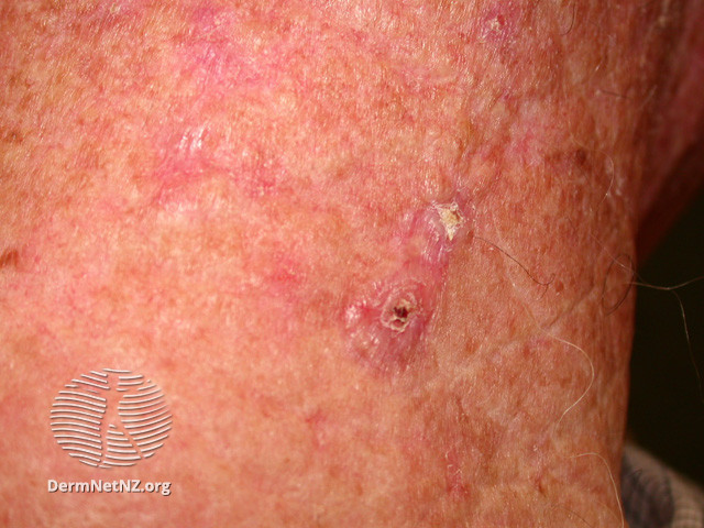 Basal cell carcinoma affecting the face (DermNet NZ lesions-bcc-face-1184).jpg