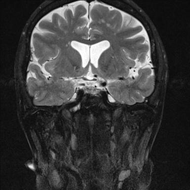 File:Base of skull chondrosarcoma (Radiopaedia 30410-31070 Coronal T2 fat sat 17).jpg