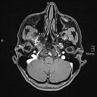 Basilar artery perforator aneurysm (Radiopaedia 82455-99523 G 14).jpg