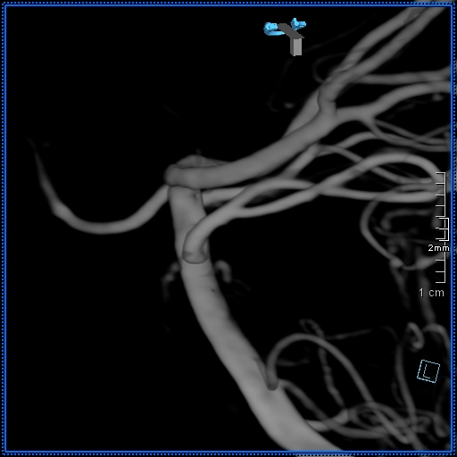 Basilar artery perforator aneurysm (Radiopaedia 82455-99524 3D Left VA 21).jpg