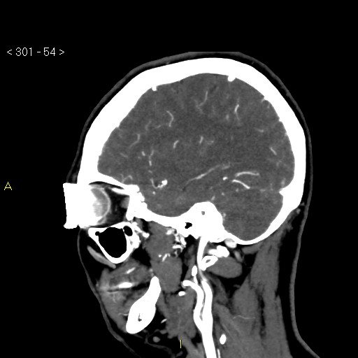 File:Basilar artery thrombosis (Radiopaedia 16260-15944 C 48).jpg