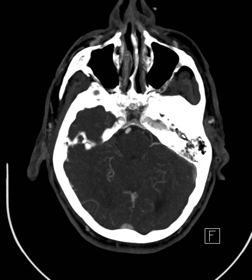 Basilar artery thrombosis (Radiopaedia 26986-27163 A 31).jpg