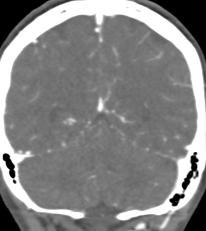 Basilar tip aneurysm with coiling (Radiopaedia 53912-60086 B 117).jpg