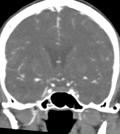 Basilar tip aneurysm with coiling (Radiopaedia 53912-60086 B 62).jpg