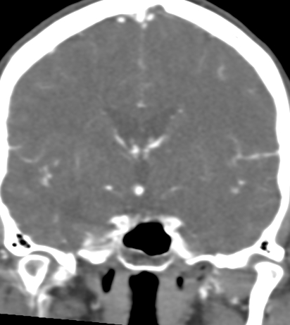 Basilar tip aneurysm with coiling (Radiopaedia 53912-60086 B 71).jpg