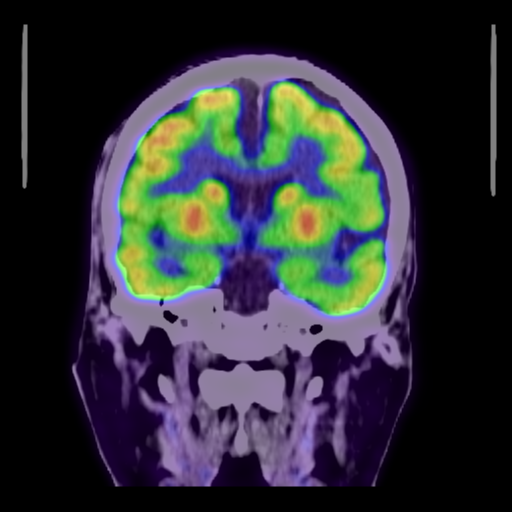 Behavioral variant frontotemporal dementia (Radiopaedia 62431-70673 B 24).png