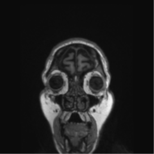 File:Behavioral variant frontotemporal dementia and late onset schizophrenia (Radiopaedia 52197-58083 Coronal T1 83).png