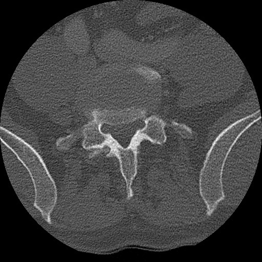 Benign post-traumatic pseudopneumoperitoneum (Radiopaedia 71199-81495 Axial bone window 270).jpg