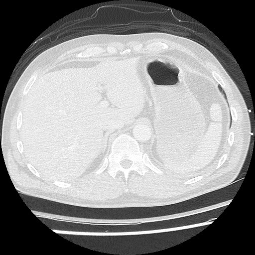 Benign post-traumatic pseudopneumoperitoneum (Radiopaedia 71199-81495 Axial lung window 65).jpg