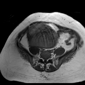 File:Benign seromucinous cystadenoma of the ovary (Radiopaedia 71065-81300 Axial T1 16).jpg