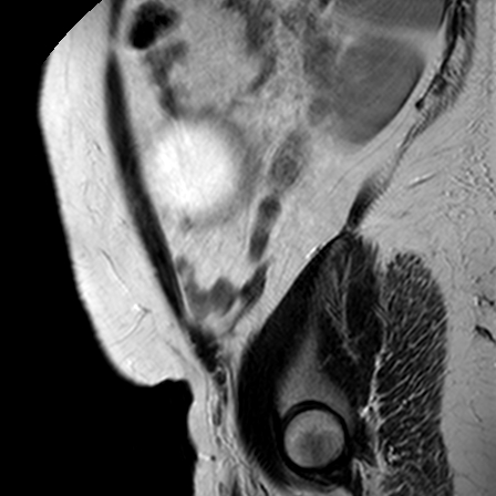 File:Benign seromucinous cystadenoma of the ovary (Radiopaedia 71065-81300 Sagittal T2 2).jpg