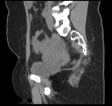 File:Bicornuate uterus (MRI) (Radiopaedia 49206-54296 Sagittal 9).png