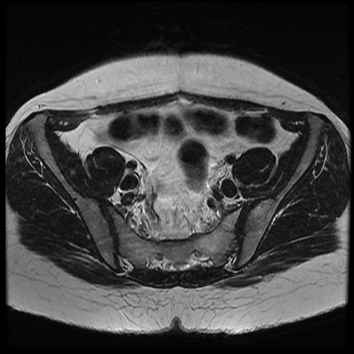 File:Bicornuate uterus (Radiopaedia 51676-57472 Axial T2 25).jpg