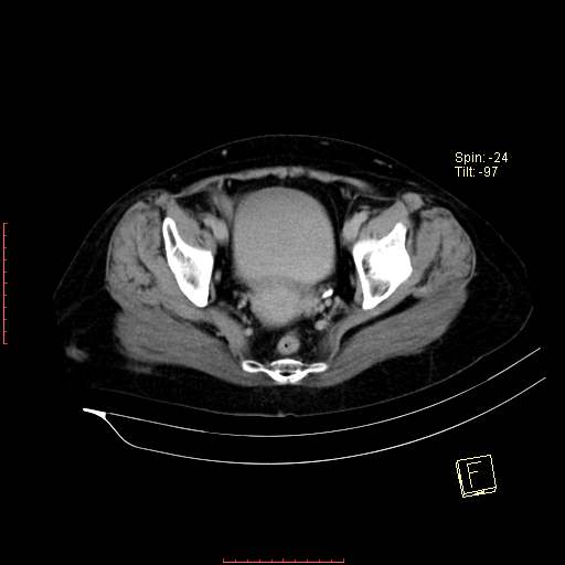 File:Bifid ureter (Radiopaedia 47604-52253 Axial C+ delayed 26).jpg