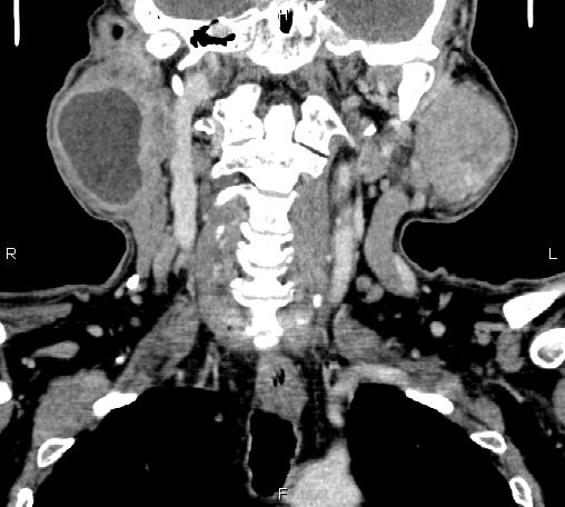File:Bilateral Warthin tumors (Radiopaedia 84034-99263 C 29).jpg