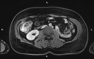 File:Bilateral adrenal myelolipoma (Radiopaedia 63058-71537 H 60).jpg