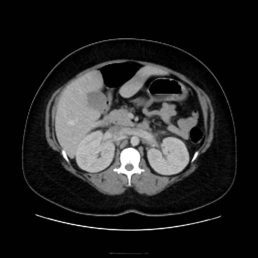 Bilateral adrenal thrombosis (Radiopaedia 58182-65256 A 26).jpg