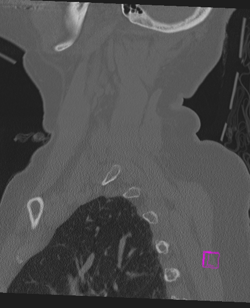 Bilateral atlanto-occipital assimilation (Radiopaedia 28350-28603 Sagittal bone window 66).jpg