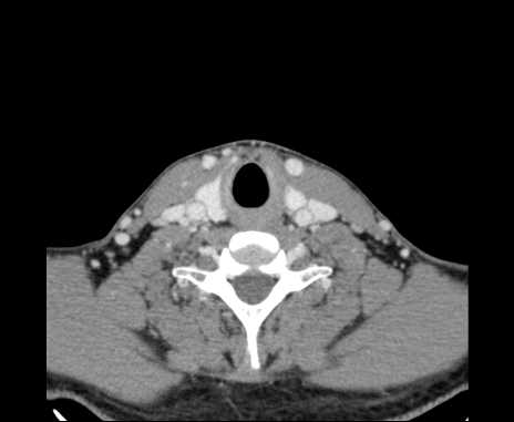 Bilateral carotid body tumors (Radiopaedia 61841-69870 Axial Post contrast 84).jpg