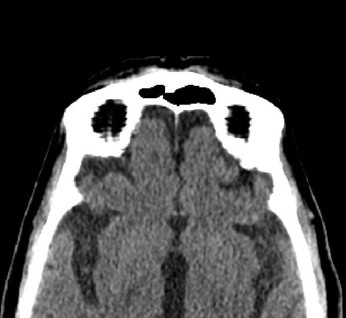 Bilateral ectopia lentis (Radiopaedia 89889-107013 Axial non-contrast 5).jpg