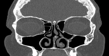 File:Bilateral ectopic infraorbital nerves (Radiopaedia 49006-54084 Coronal 44).png