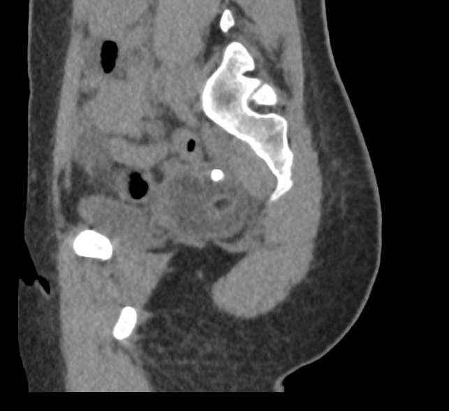 Bilateral mature cystic ovarian teratoma (Radiopaedia 88821-105592 D 51).jpg