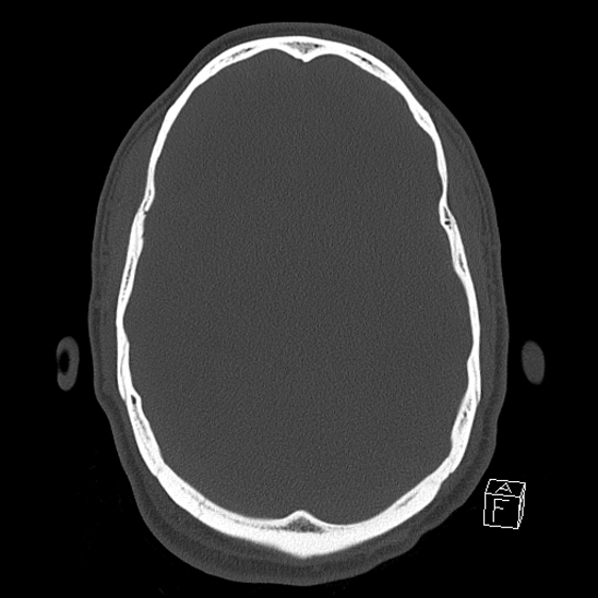 Bilateral occipital condyle fracture (type 2) (Radiopaedia 87675-104089 Axial bone window 60).jpg