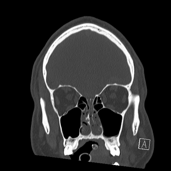 Bilateral occipital condyle fracture (type 2) (Radiopaedia 87675-104089 Coronal bone window 17).jpg