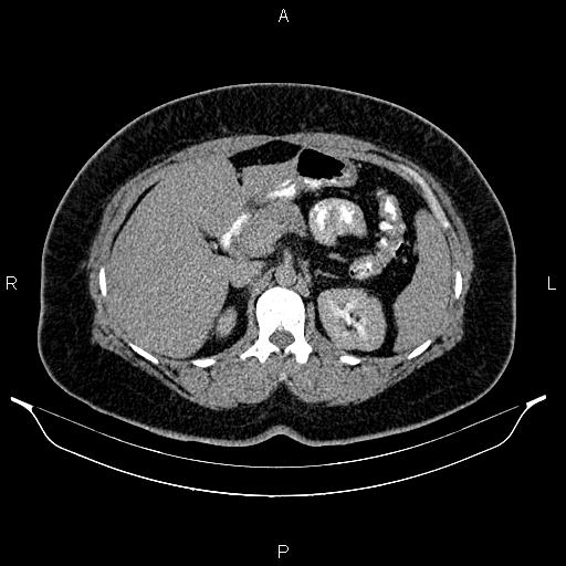 Bilateral ovarian dermoid cysts (Radiopaedia 85785-101603 Axial C+ delayed 19).jpg