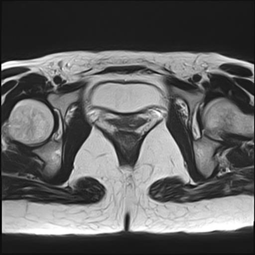 File:Bilateral ovarian endometriomas (Radiopaedia 87085-103347 Axial T2 18).jpg