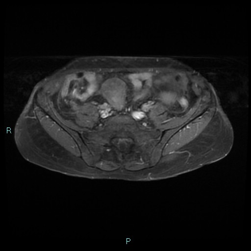 File:Bilateral ovarian fibroma (Radiopaedia 44568-48293 Axial T1 C+ fat sat 4).jpg