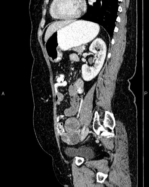 Bilateral ovarian serous cystadenocarcinoma (Radiopaedia 86062-101989 E 57).jpg