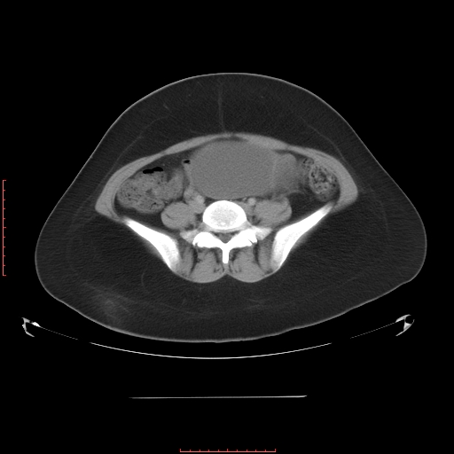 File:Bilateral ovarian serous cystadenocarcinoma with right ovarian torsion (Radiopaedia 32640-33611 A 29).jpg