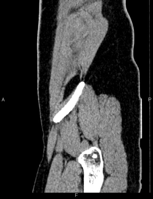 Bilateral ovarian teratoma (Radiopaedia 83131-97503 D 23).jpg