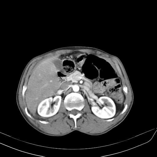 Bilateral parotid gland lymphoma (Radiopaedia 21038-20969 A 57).jpg