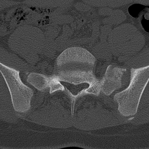 File:Bilateral pars defect (Radiopaedia 26691-26846 Axial bone window 72).jpg
