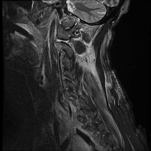 File:Bilateral perched facets with cord injury (Radiopaedia 45587-49714 Sagittal STIR 15).jpg