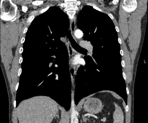 File:Bilateral pulmonary AVM (Radiopaedia 83134-97505 C 44).jpg