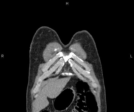 Bilateral pulmonary AVM (Radiopaedia 83134-97505 C 7).jpg