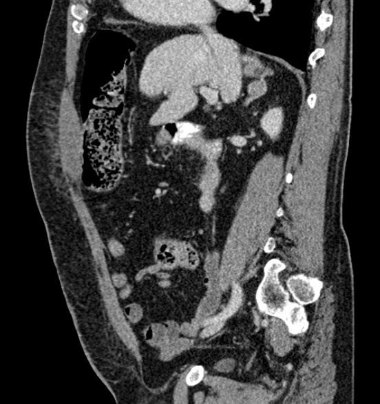 Bilateral rectus sheath hematomas (Radiopaedia 50778-56252 B 32).jpg