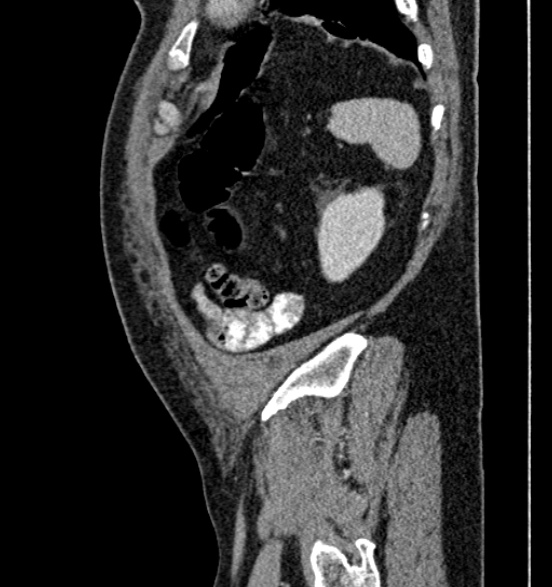 Bilateral rectus sheath hematomas (Radiopaedia 50778-56252 B 67).jpg