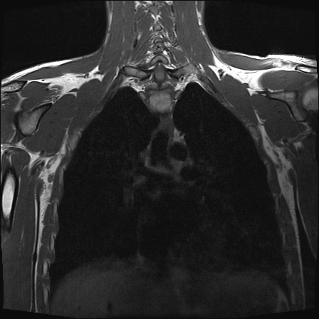 File:Bilateral spinoglenoid notch ganglion cysts (Radiopaedia 29577-30082 Coronal T1 17).jpg