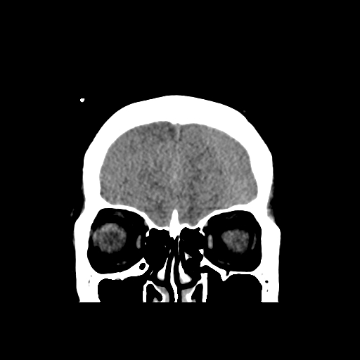 Bilateral subacute subdural hematoma (Radiopaedia 69240-79018 Coronal non-contrast 9).jpg