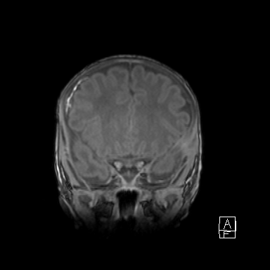 Bilateral subdural hemorrhage and parietal skull fracture (Radiopaedia 26058-26190 Coronal T1 17).png