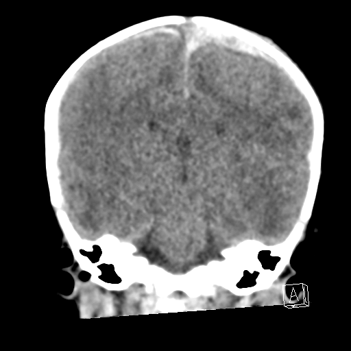 File:Bilateral subdural hemorrhage and parietal skull fracture (Radiopaedia 26058-26192 Coronal non-contrast 16).png