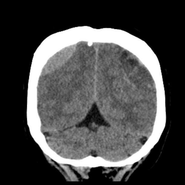 Bilateral subdural hemorrhages (Radiopaedia 26588-26732 Coronal non-contrast 48).jpg